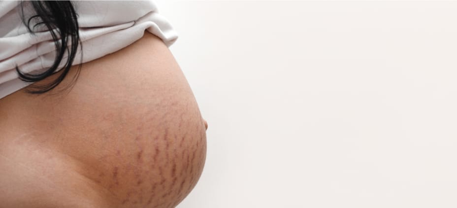 Stretch marks in pregnancy and their prevention
